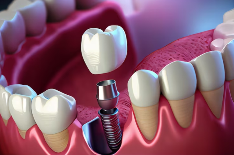 What You Should Know About Dental Implants?
